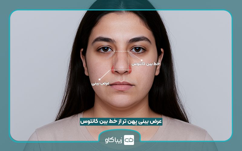 تفاوت بینی گوشتی و استخوانی