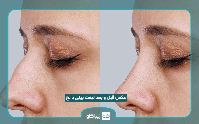 عکس قبل و بعد لیفت بینی با نخ