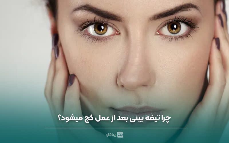 چرا تیغه وسط بینی بعد از عمل کج میشود؟ نکات مهم جراحی بینی 🌟