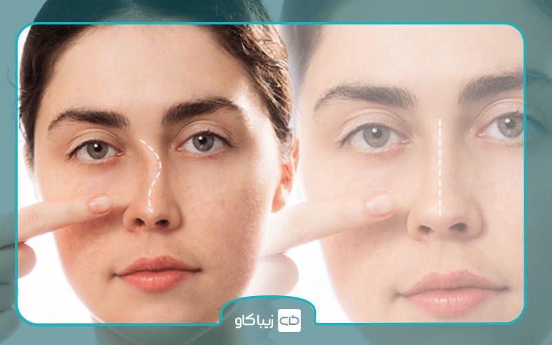 درمان کجی تیغه بینی